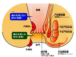 いぼ痔とは