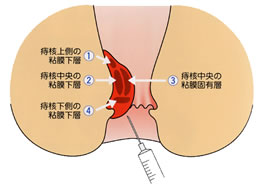 ジオン注